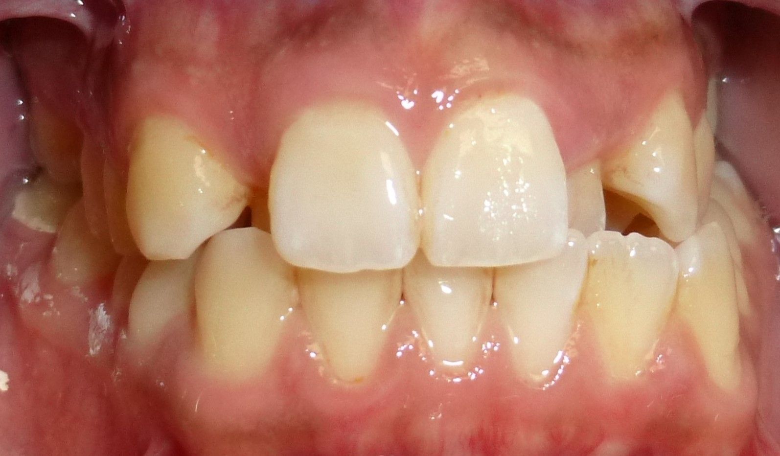 A close-up view of a person's teeth showing dental crowding and a crossbite with the upper and lower teeth misaligned.