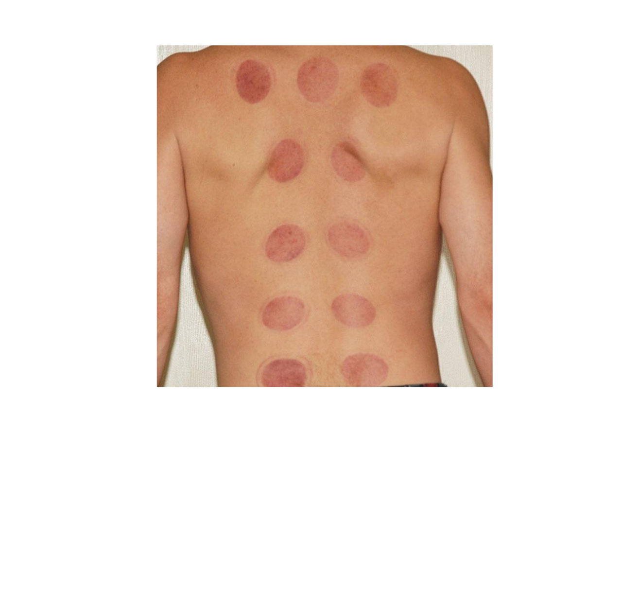 Cupping therapy