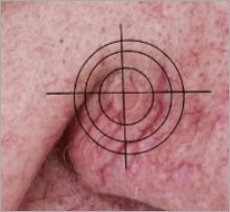 Skin Cancer Page small photo