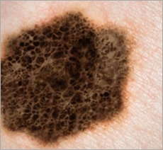 Melanoma Pic for Mohs Skin Cancer Page Header