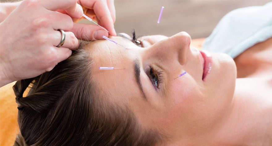 Acupuncture
