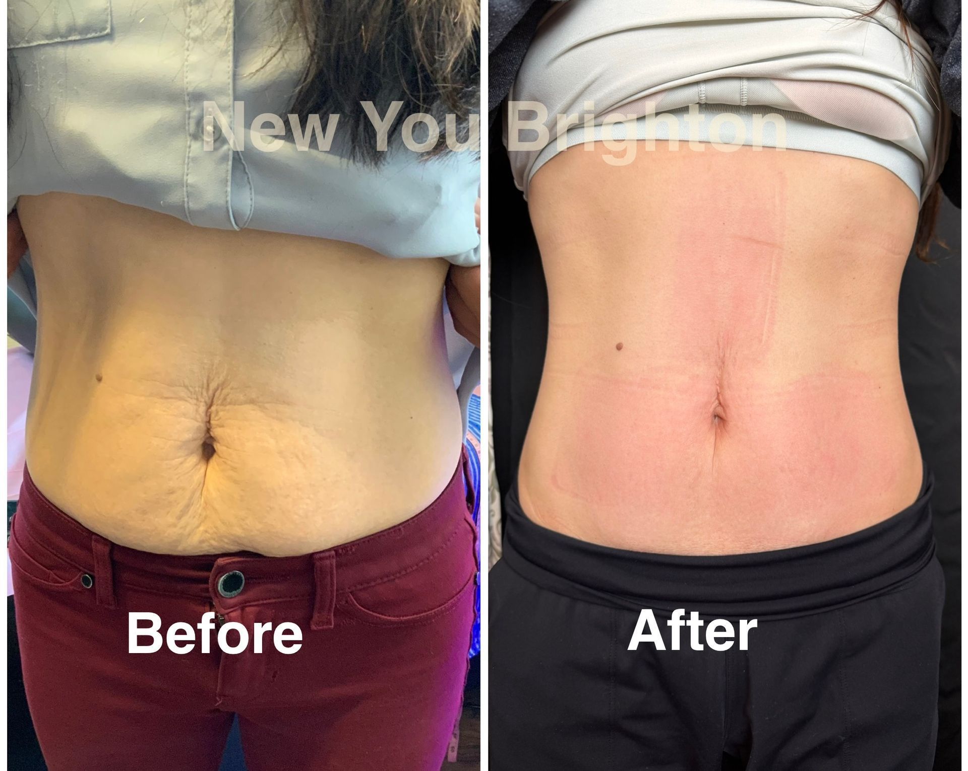 Side-by-side torso comparison labeled Before and After, showing a flatter abdomen after treatment