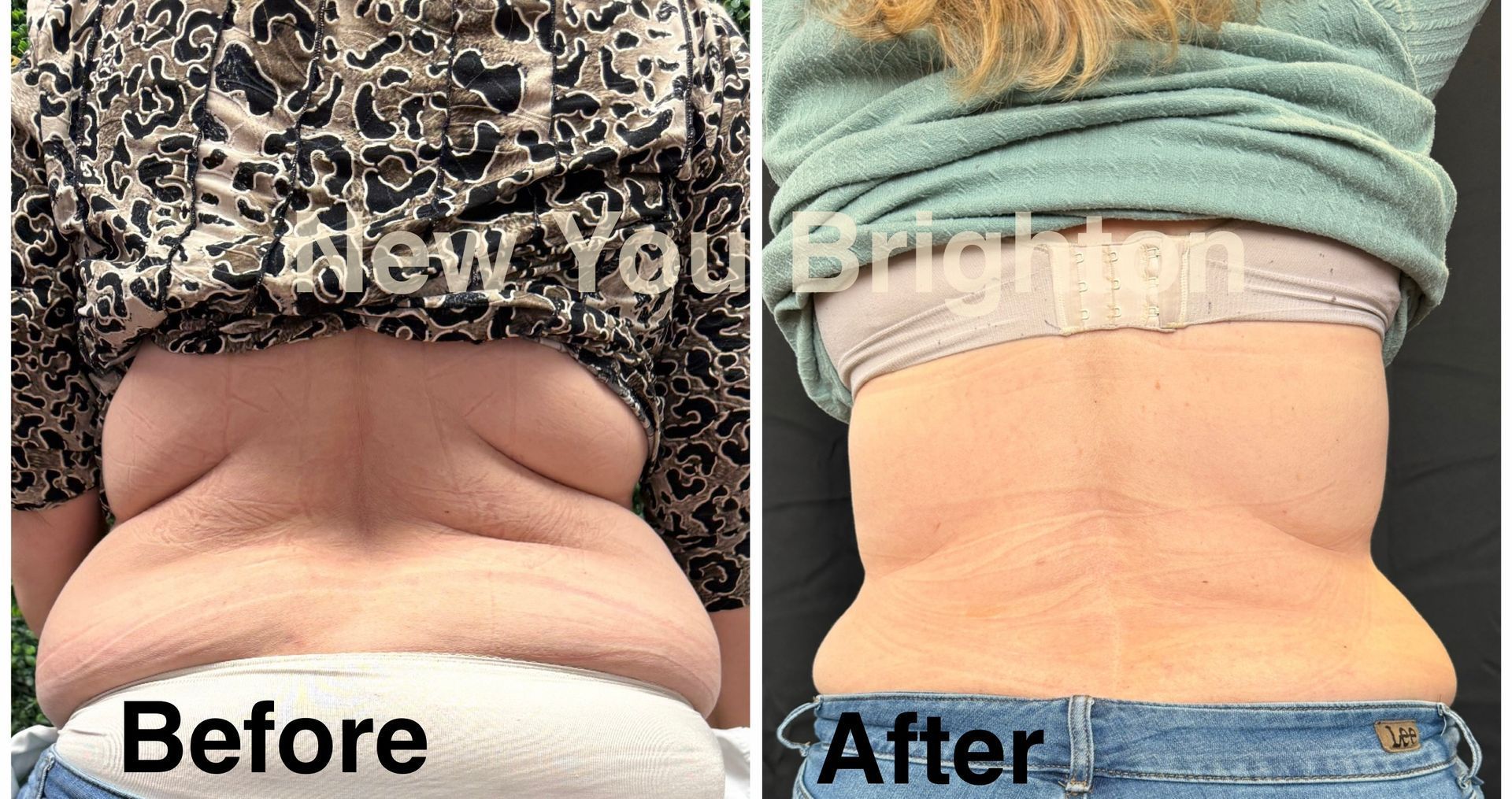 Side-by-side Before and After waist comparison: pronounced back rolls reduced to a smoother waistline.