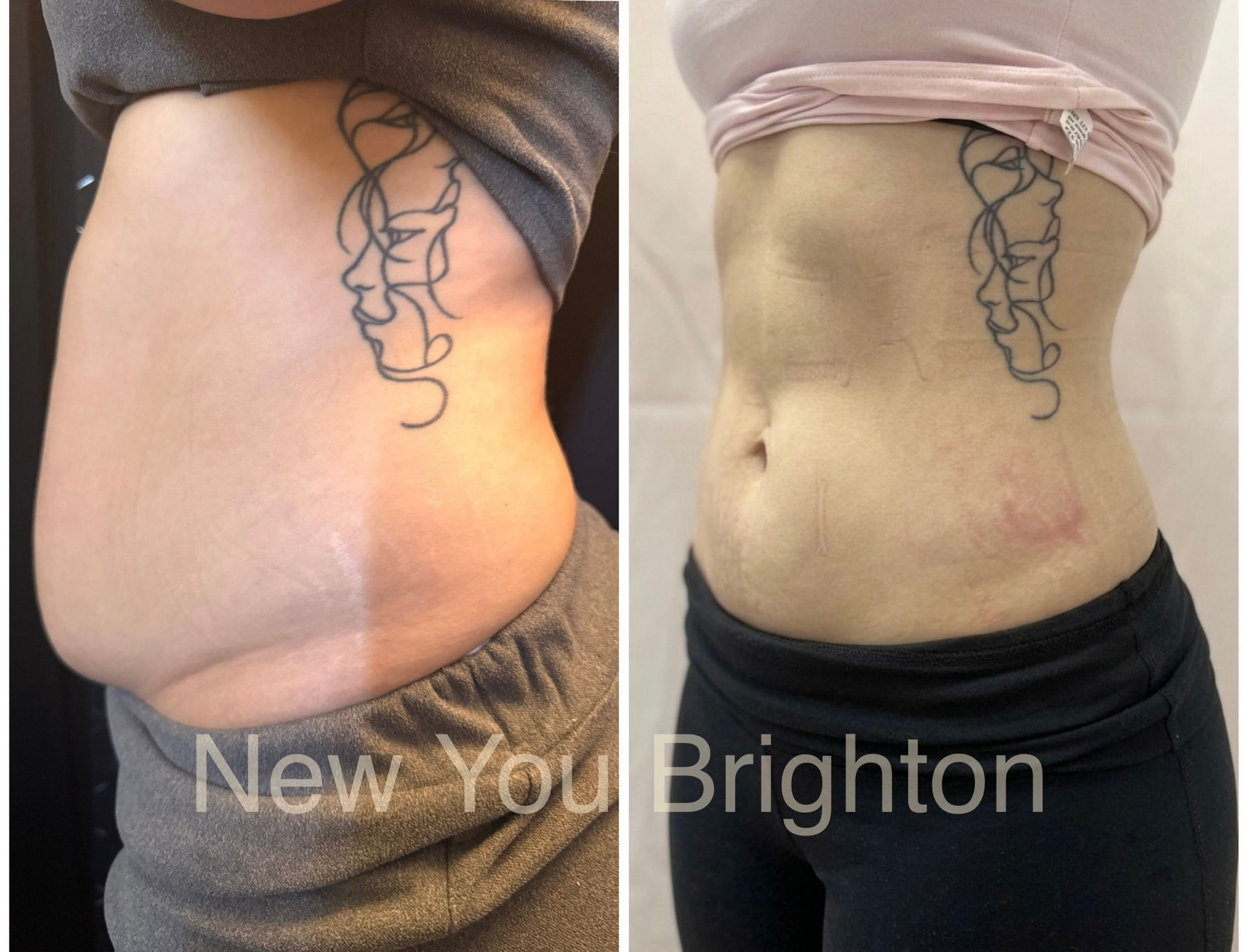 Side-by-side torso before-and-after photos showing slimmer waist and abdomen
