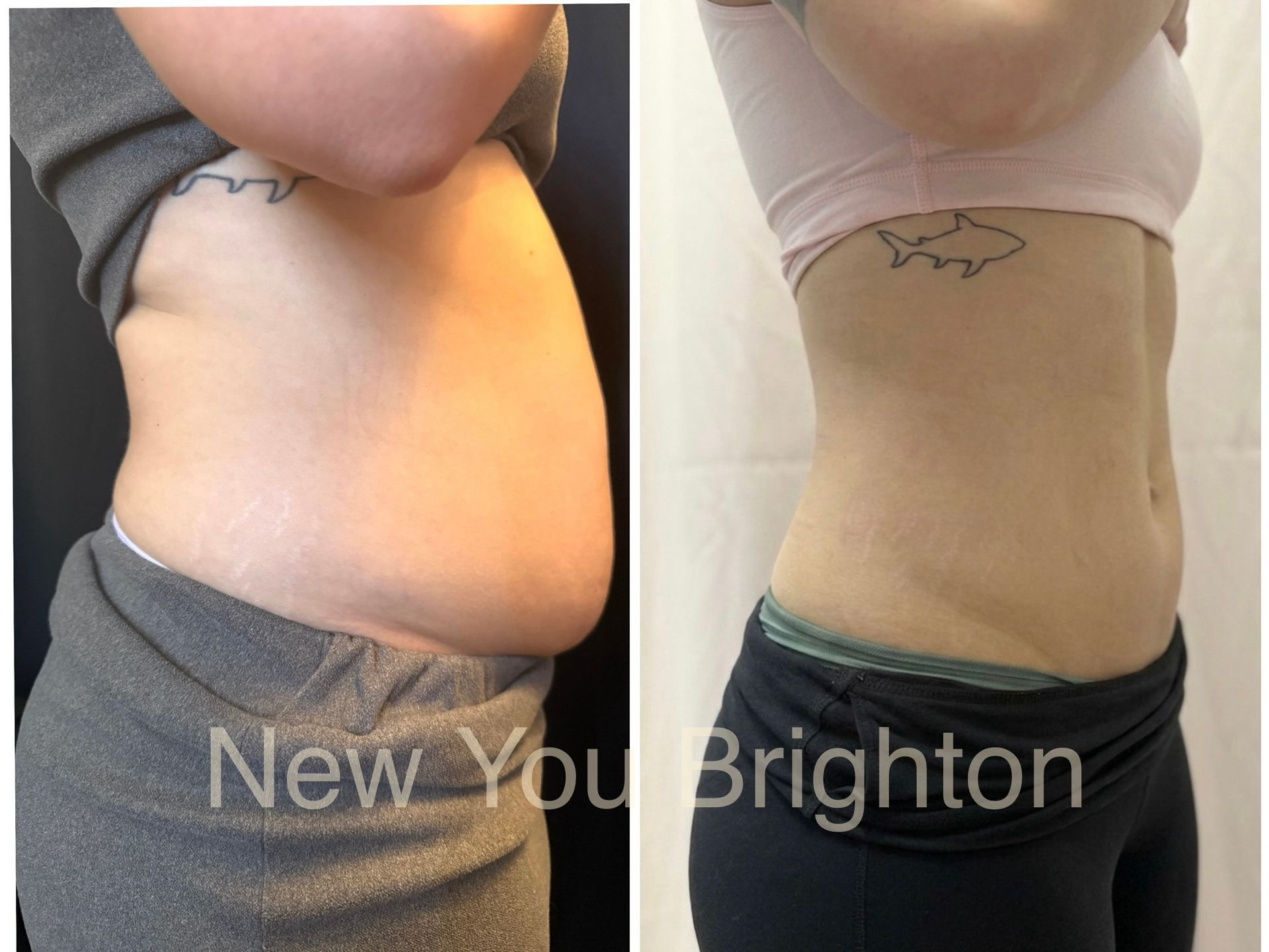 Side-by-side torso comparison showing a slimmer waist and flatter stomach after weight loss.
