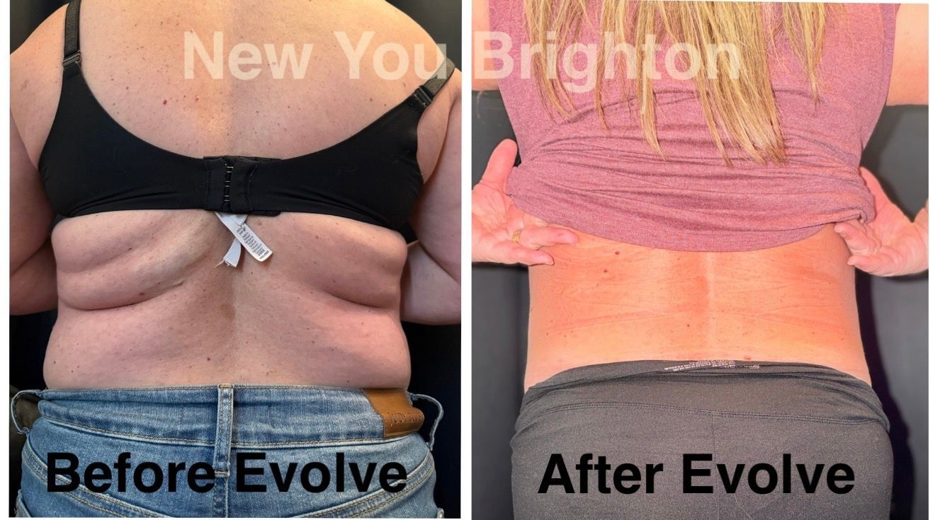 Side-by-side torso photos labeled Before Evolve and After Evolve, showing flattened abs after treatment.
