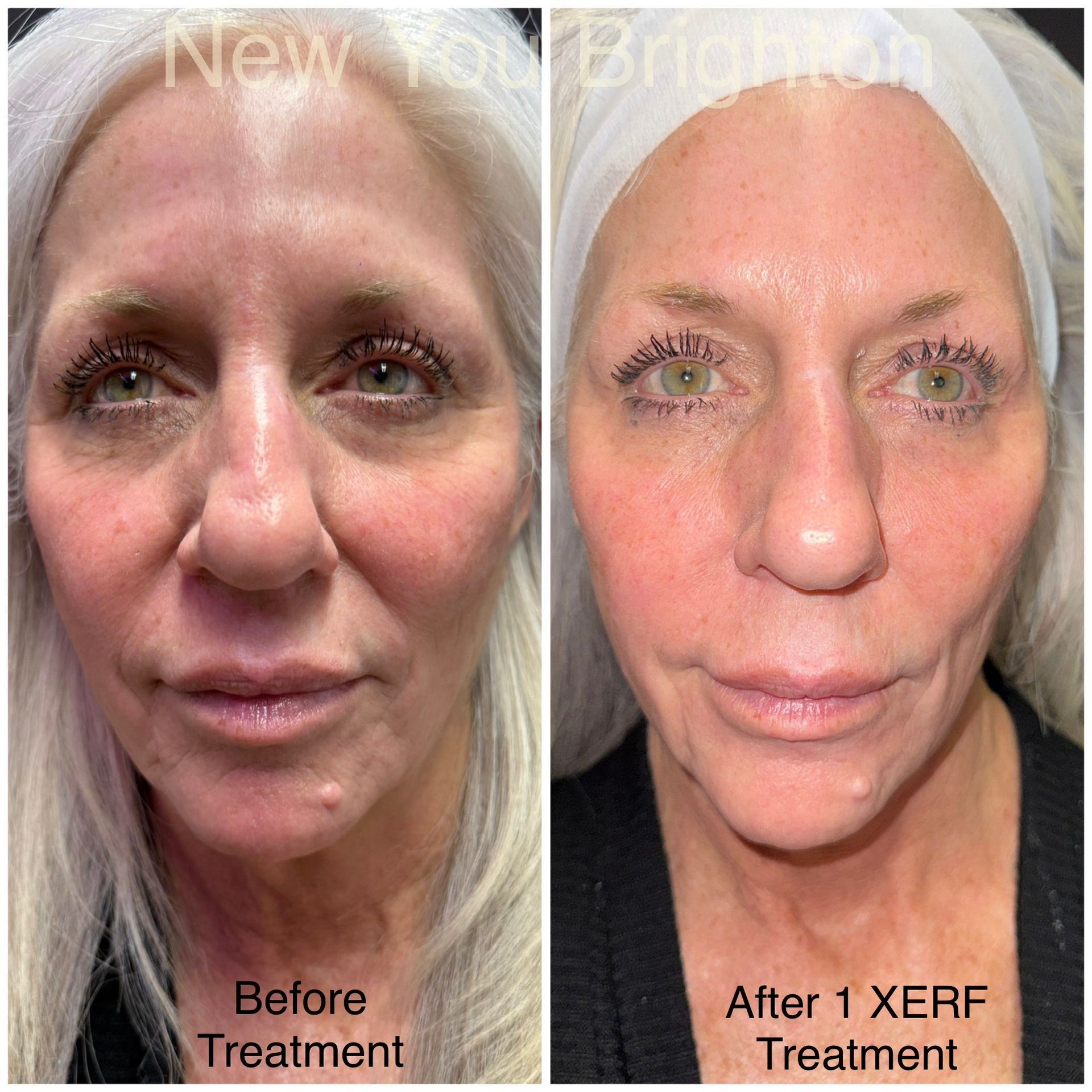 Side-by-side view of a woman's face before and after an XERF treatment, showinga  reduction in wrinkles and improved skin tone.