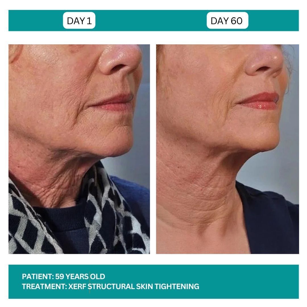 Side-by-side comparison of a person's neck and face, Day 1 vs. Day 60, showing skin tightening effects.