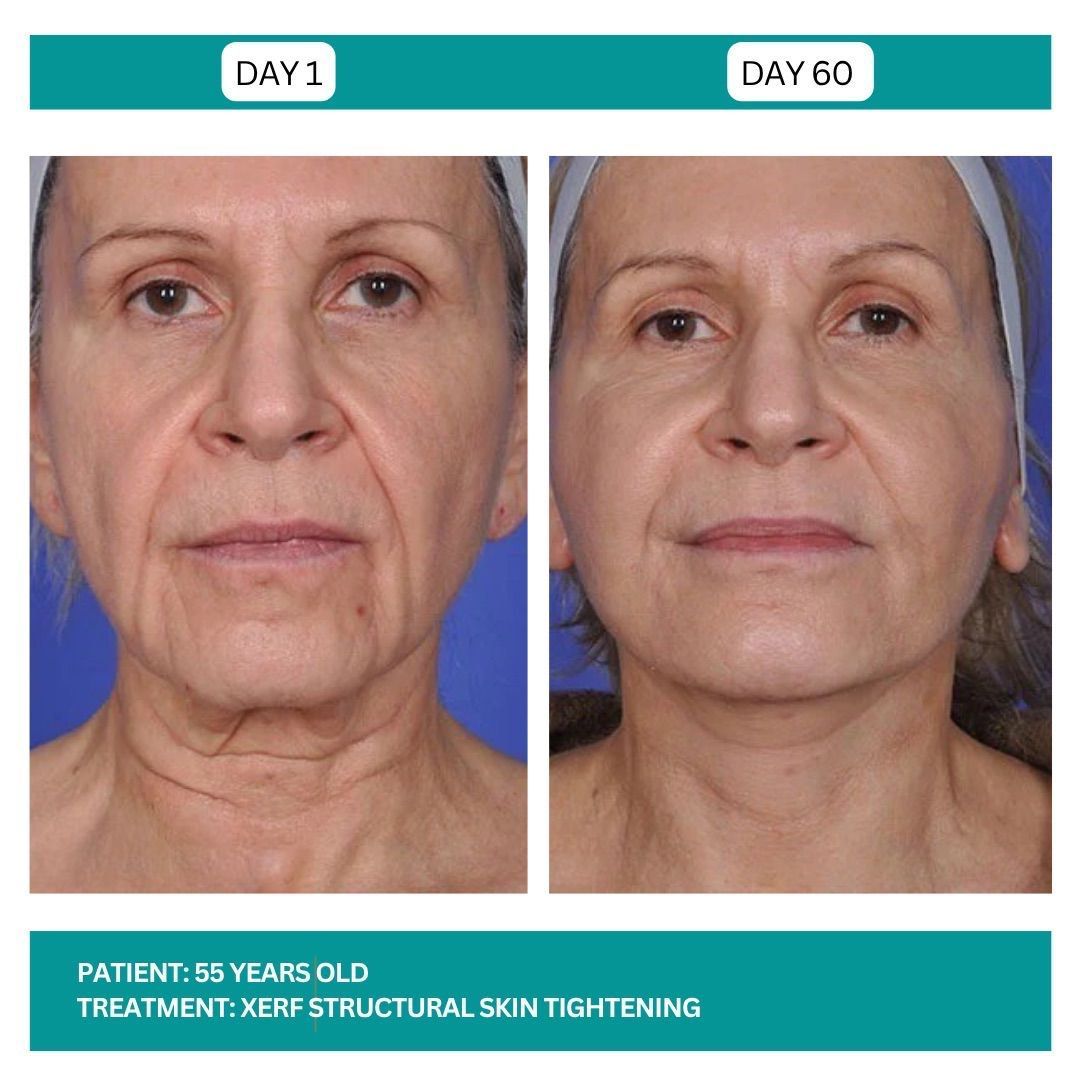 Before and after facial skin tightening. A 55-year-old patient. 