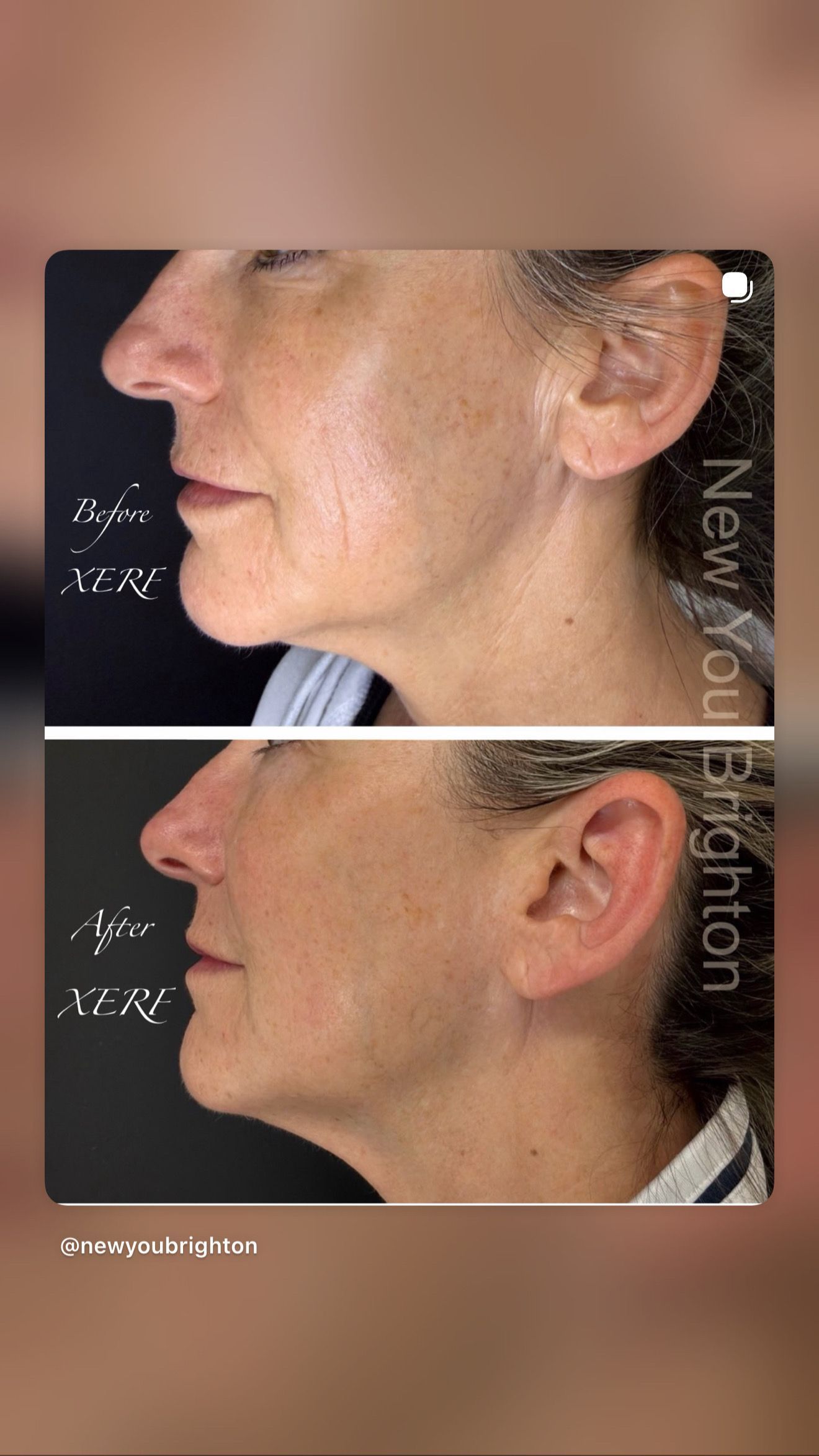 Side-by-side side profiles of a womans face, showing before-and-after skin treatment results.