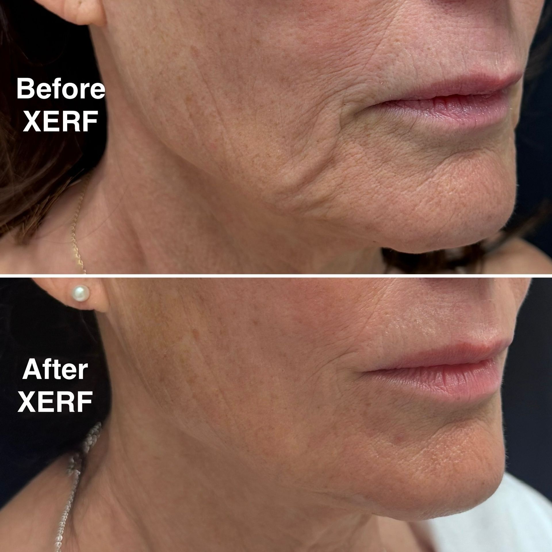 Before-and-after close-up of a persons jawline and chin labeled Before XERF and After XERF