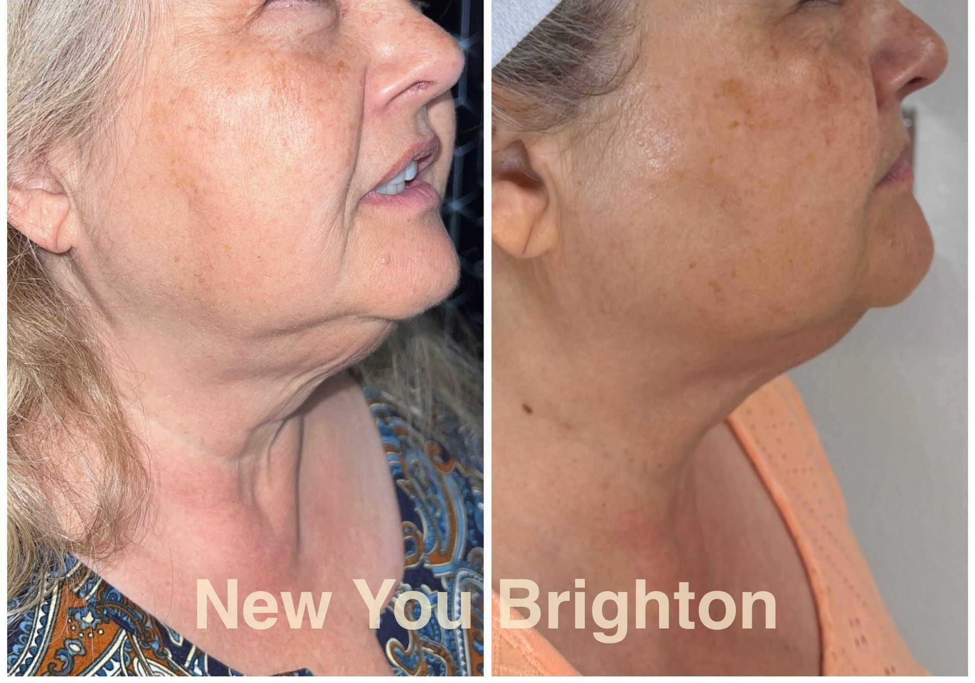 Side-by-side profile photos of a womans neck and jawline before and after treatment with different skin tones.