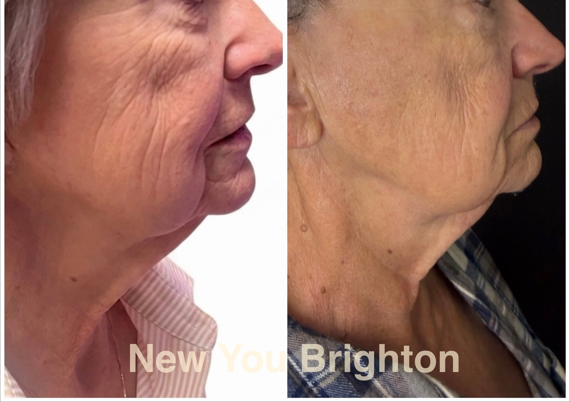 Side-by-side profile photos showing neck skin before and after treatment.