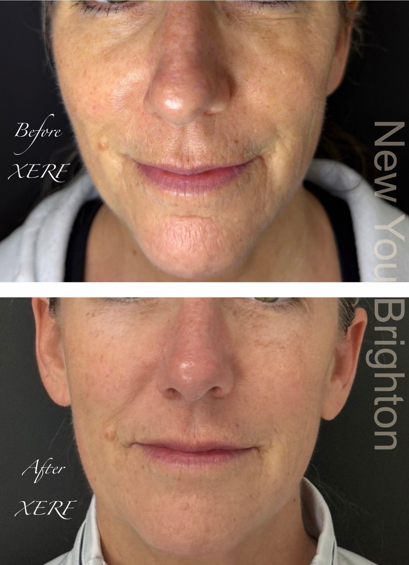 Before-and-after close-up of a womans face showing smoother skin after treatment, with Before and After labels.