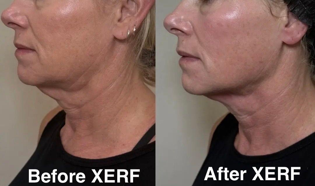 Side-by-side profile photos labeled Before XERF and After XERF, showing a tighter-looking neck and jawline.