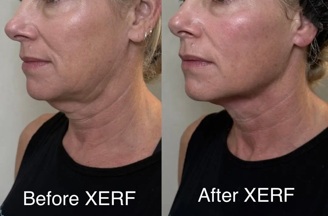 Side-by-side profile photos labeled Before XERF and After XERF, showing a smoother neck and jawline after treatment