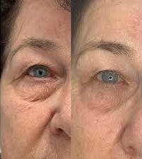 Comparison of a person's eye area: before and after appearance. The