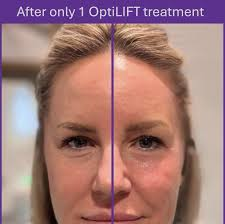 Side-by-side view of woman's face, one side smooth, other with lines, after OptiLIFT treatment.