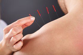 Patient receiving acupuncture treatment on shoulder