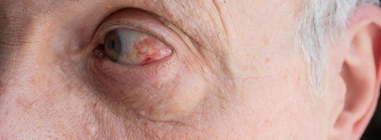 senior old man with red capillars inflammation