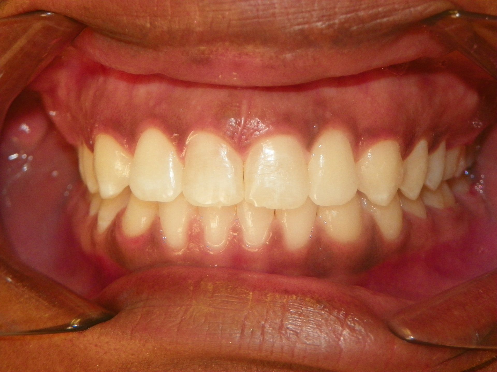 J Taylor after ortho