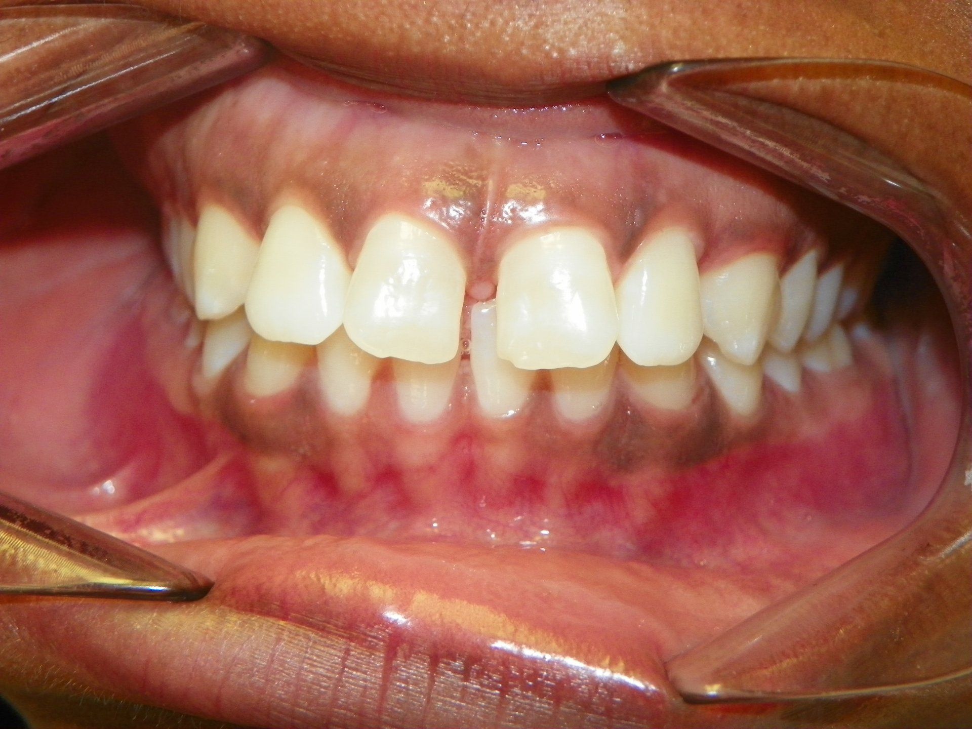 J Taylor before ortho