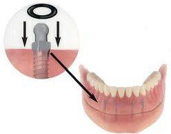 Implant Restorations