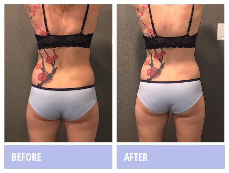 Tattooed  woman's back  before and after photo