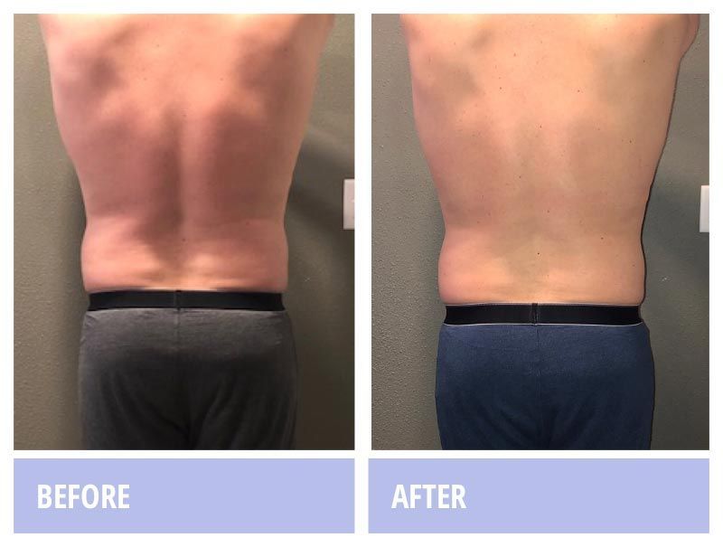 Man's back  before and after photo