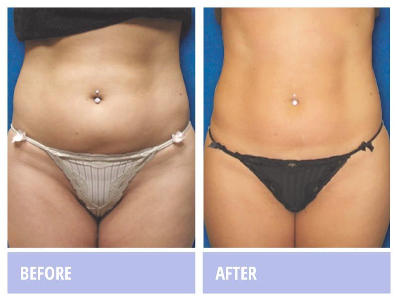Woman's belly before and after photo