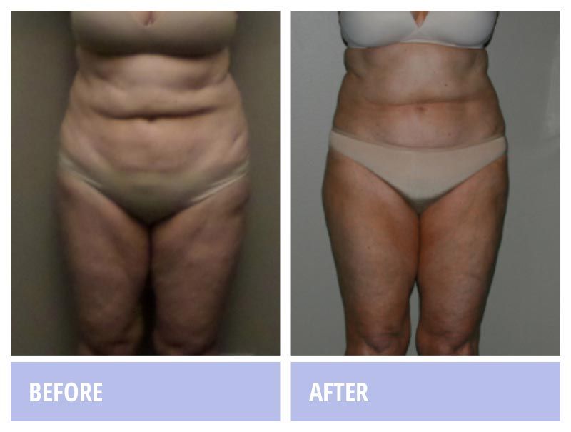 Woman's belly before and after photo