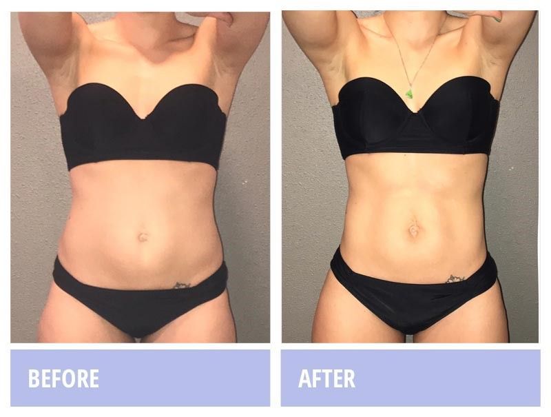 Woman's belly before and after photo sculpting