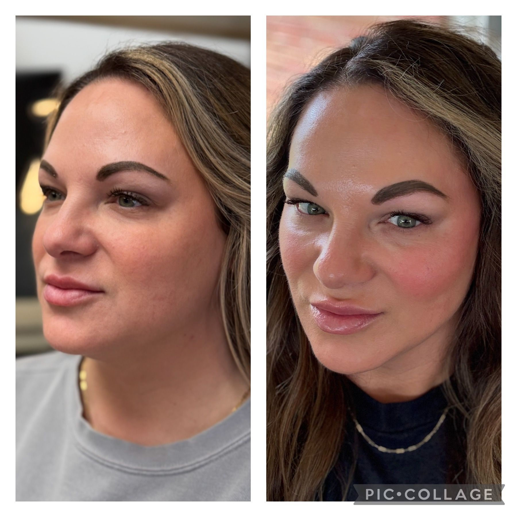 Before and after Scarlet microneedling