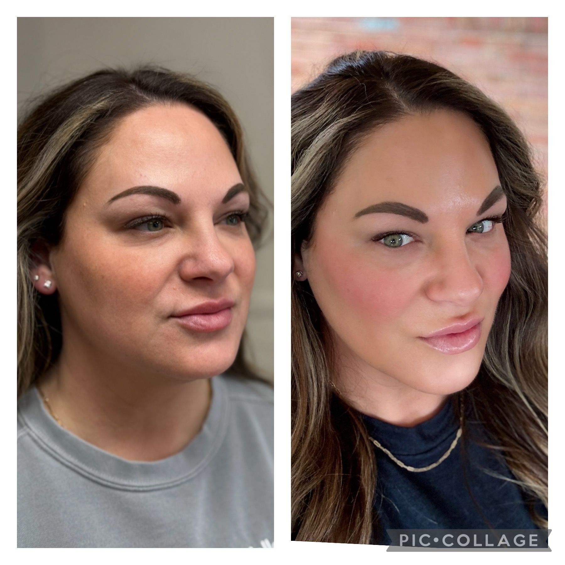 Before and after Scarlet microneedling