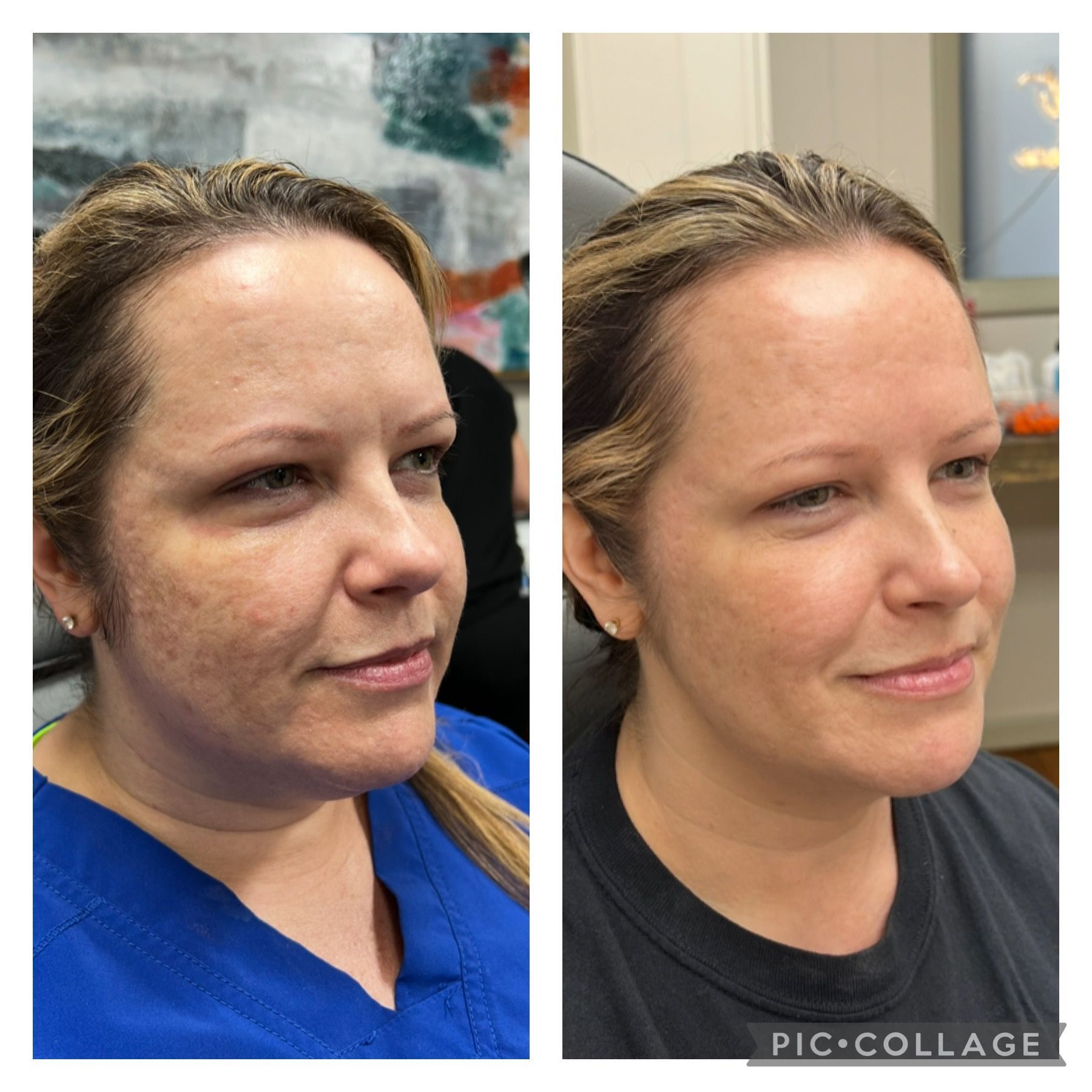 Before and after Scarlet microneedling