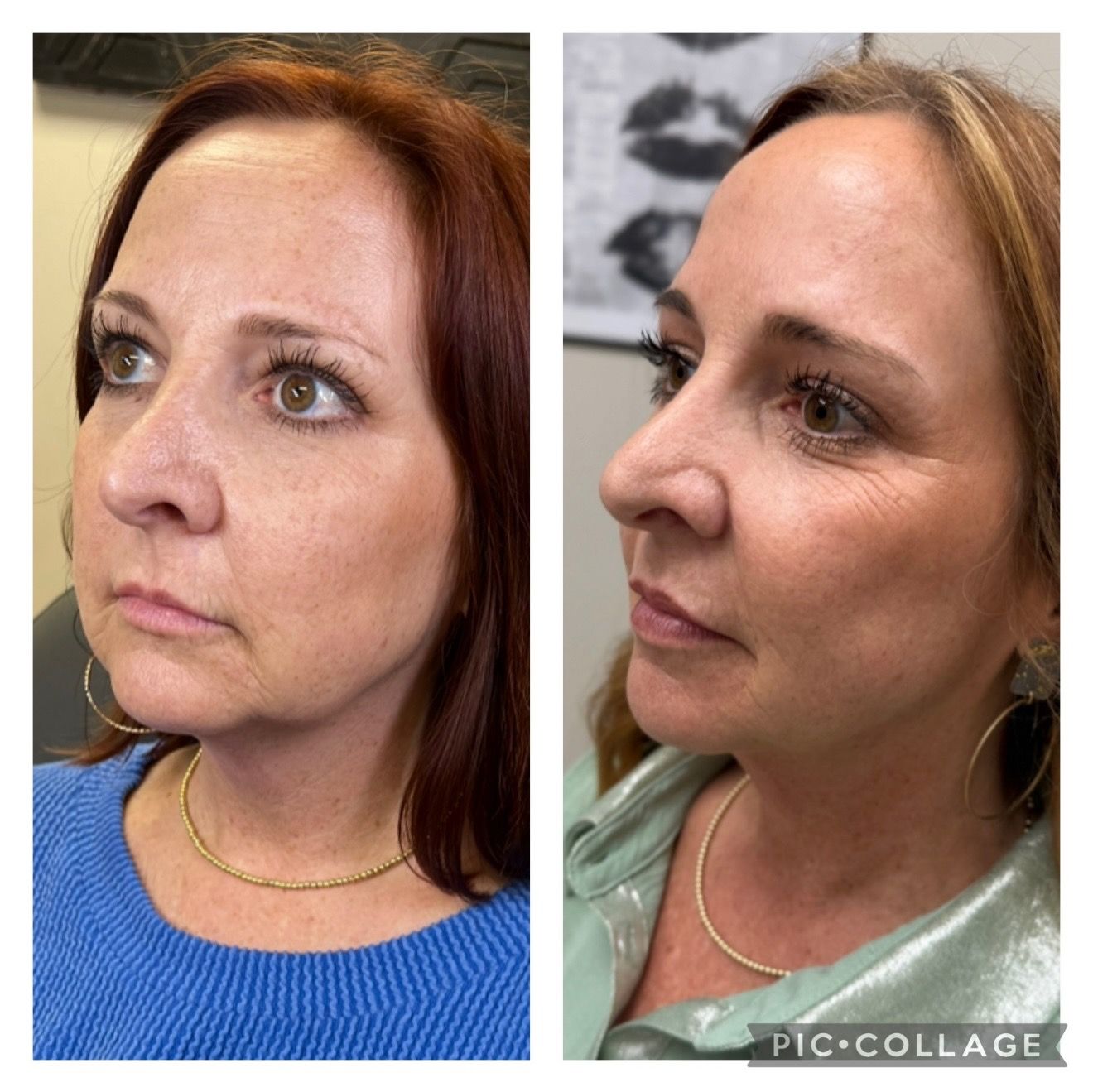 Before and after Scarlet microneedling