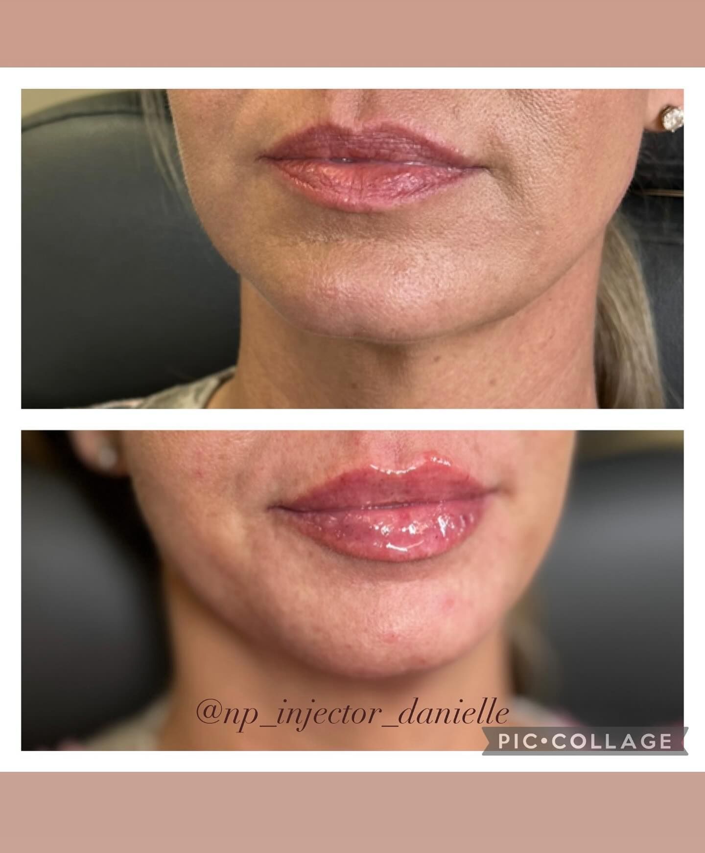 A before and after photo of a woman 's lips.