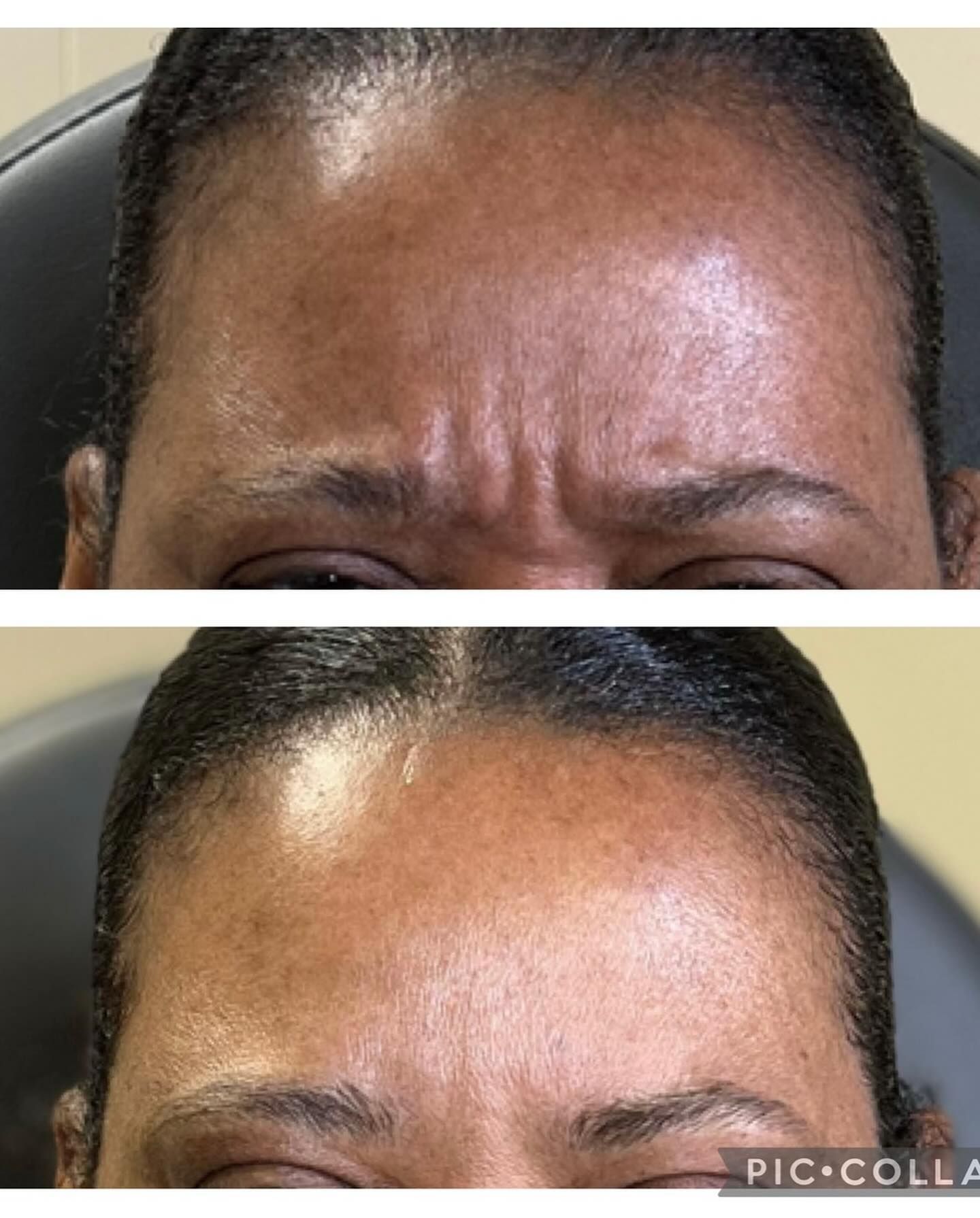 A before and after photo of a woman 's forehead with wrinkles.