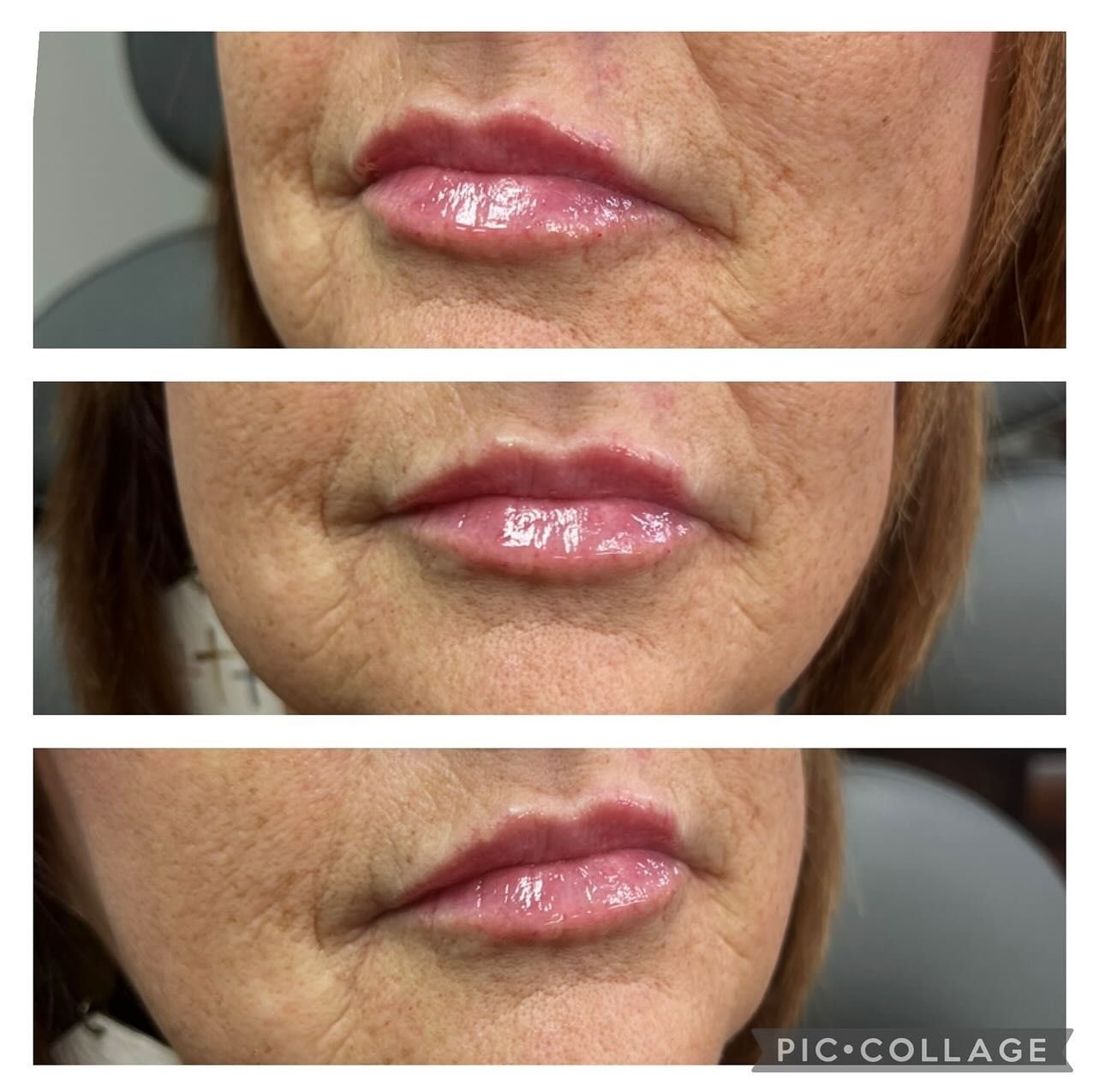 A before and after picture of a woman 's lips.