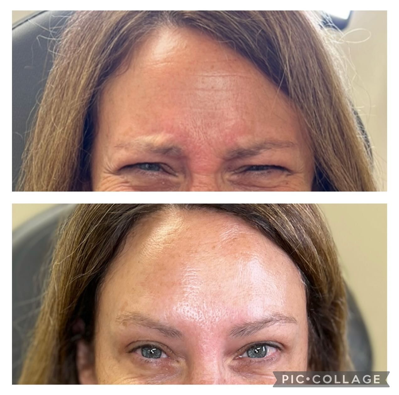 A before and after photo of a woman 's forehead.
