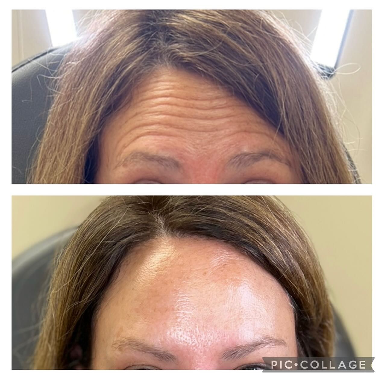 A before and after photo of a woman 's forehead