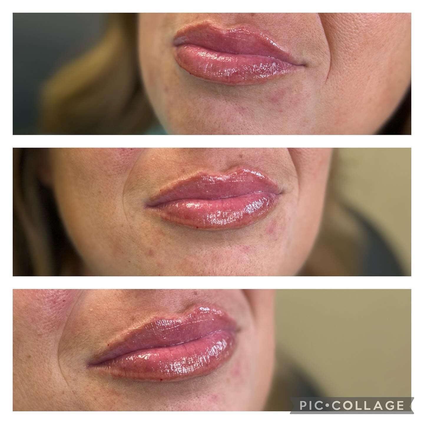 Three pictures of a woman 's lips before and after lip filler