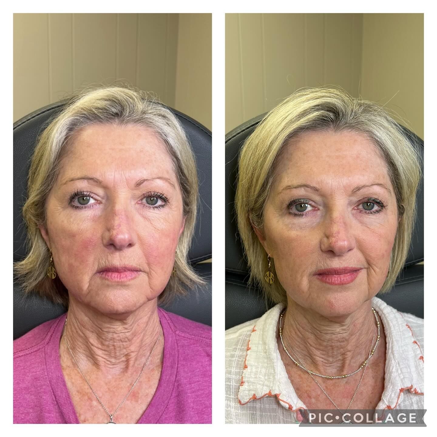 A before and after photo of a woman 's face.