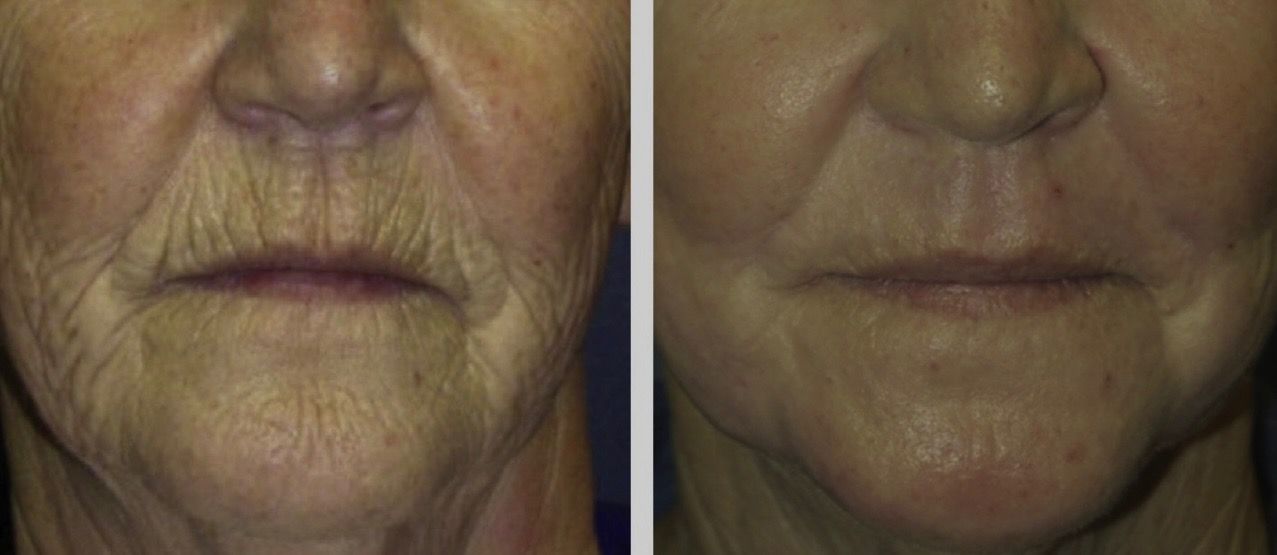 Before and after photo