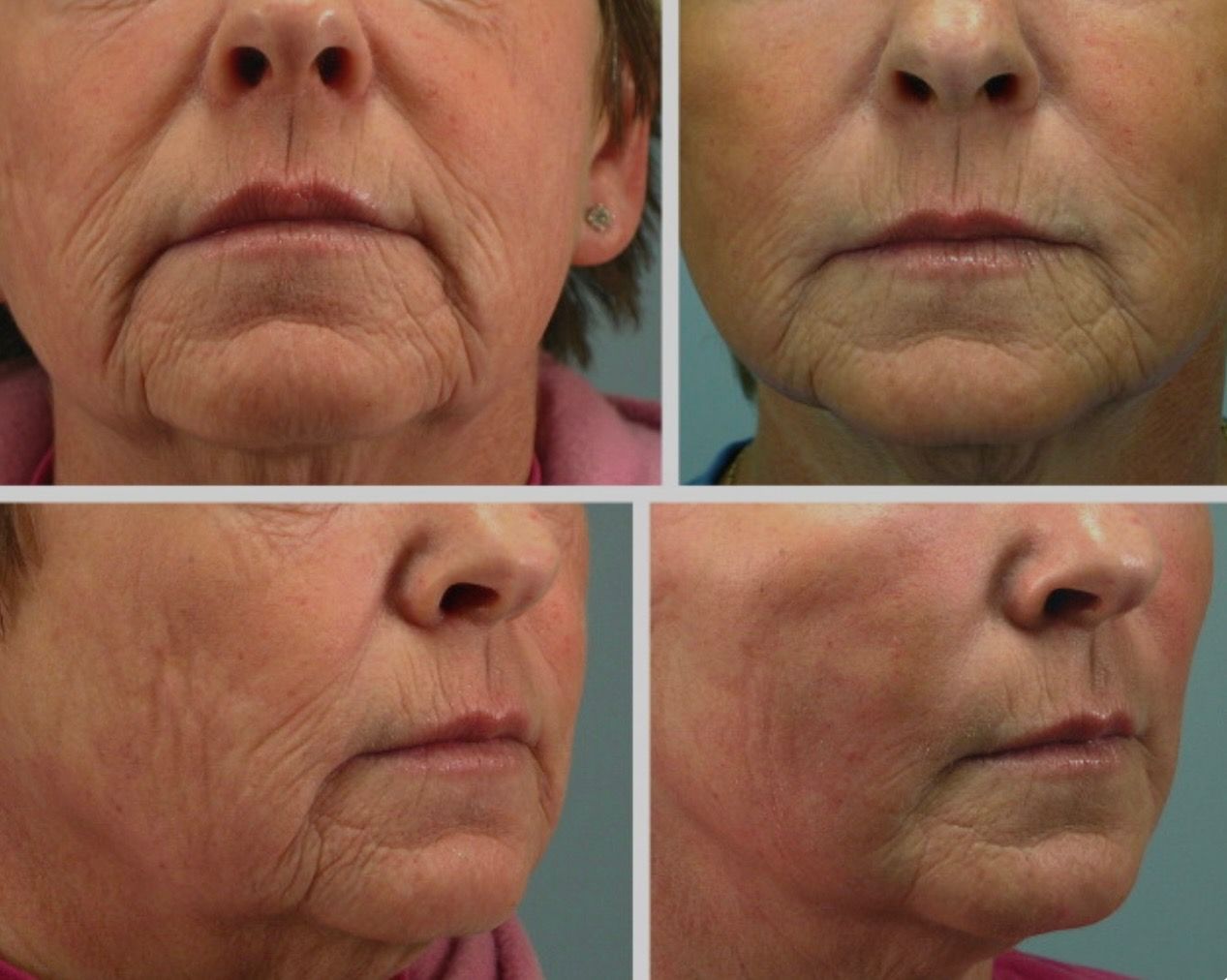 Before and after photo