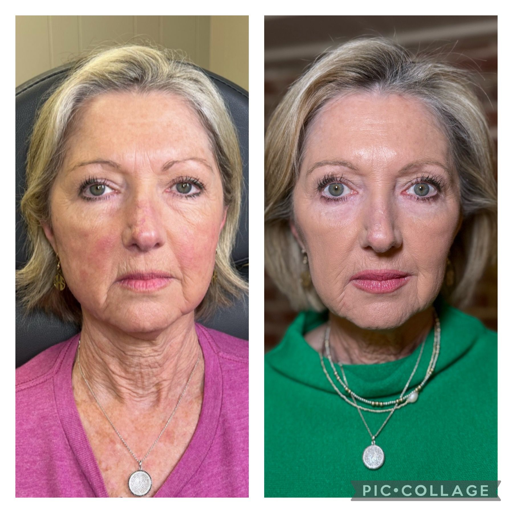 A before and after photo of a woman 's face.