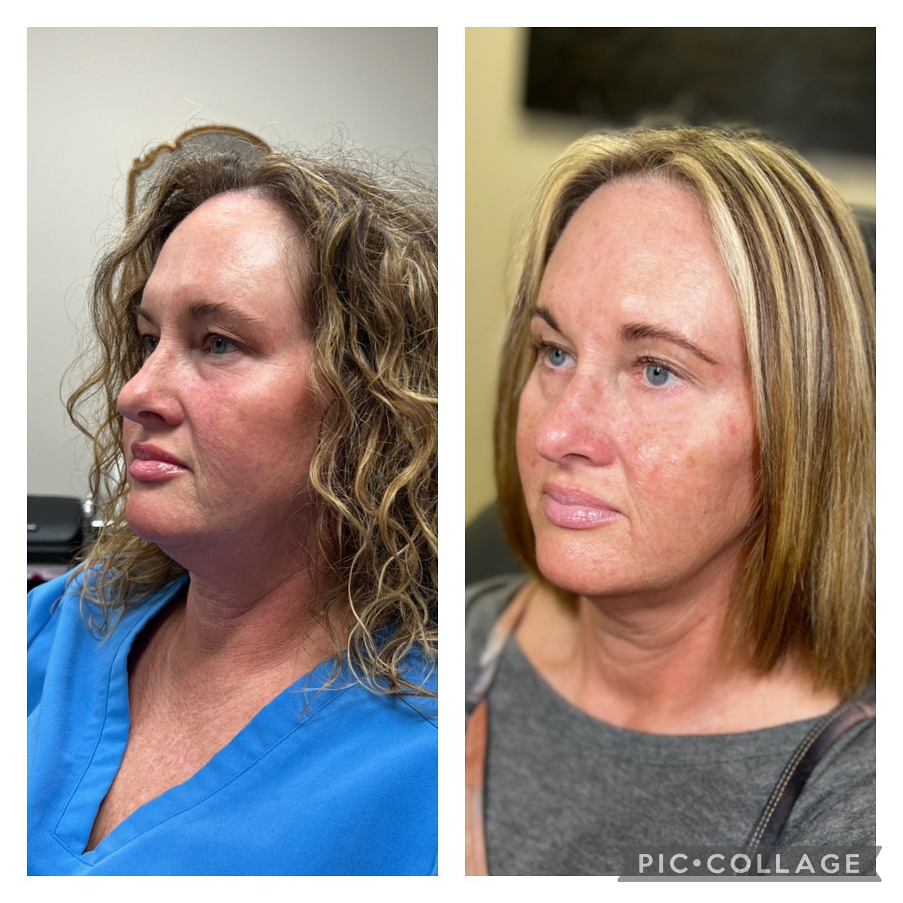 A before and after photo of a woman 's face