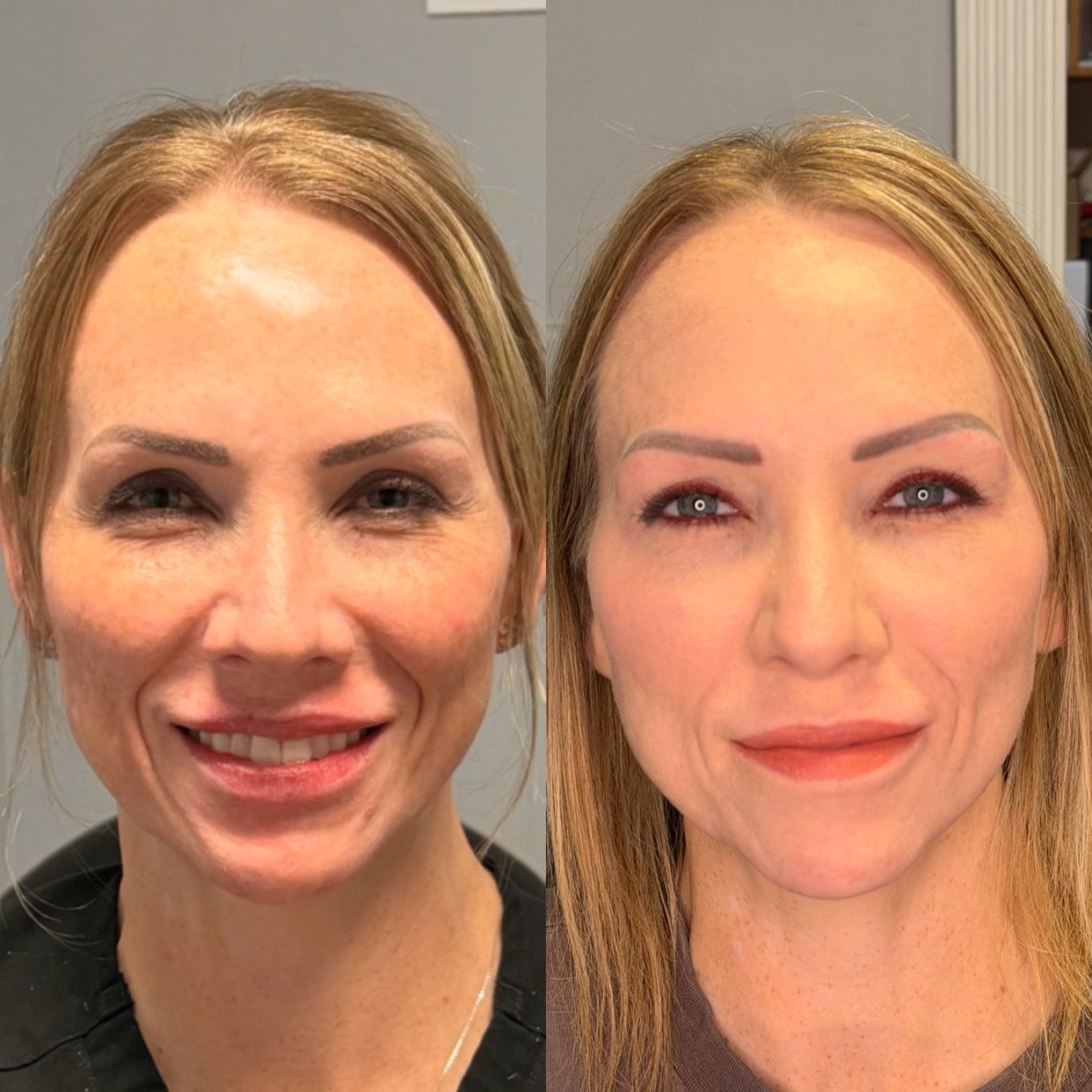 Side-by-side portrait of a woman before and after cosmetic treatment, smiling slightly