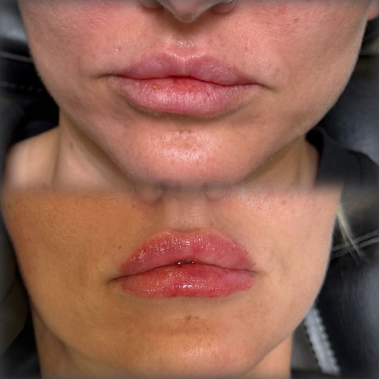 Close-up of lips before and after treatment, showing improved redness and smoother appearance