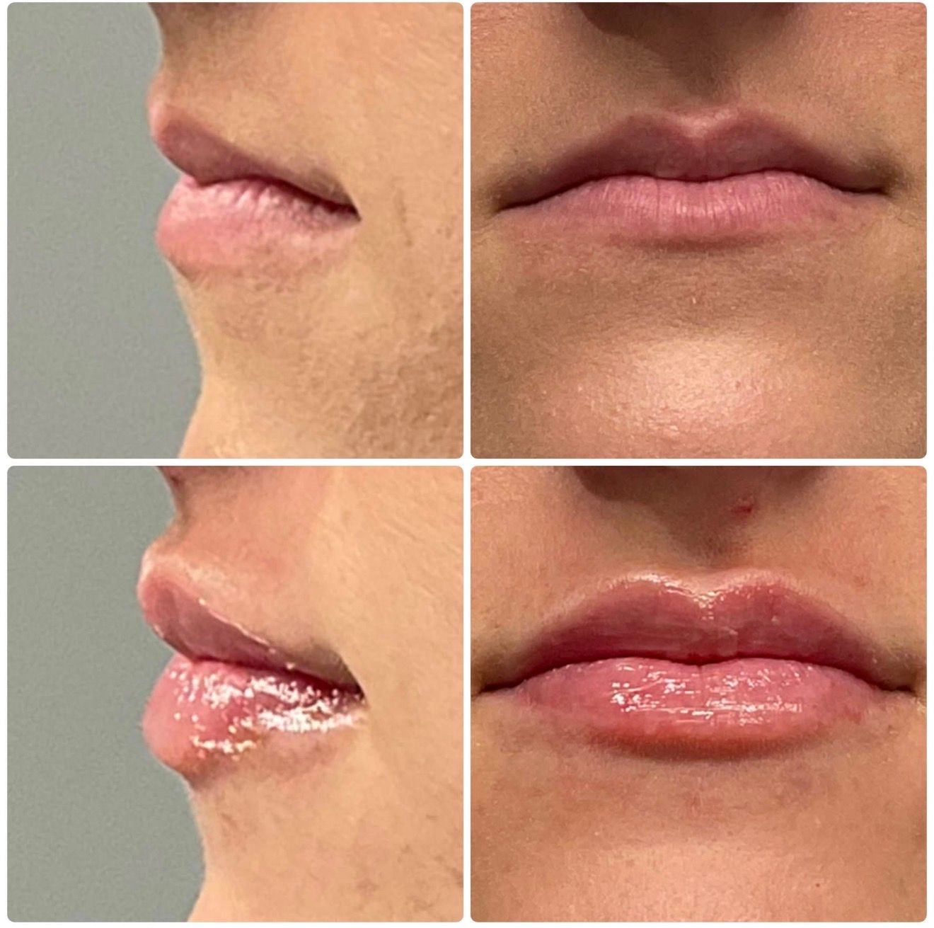 Close-up four-panel lip before-and-after, showing chapped lips with balm applied and a glossier finish.